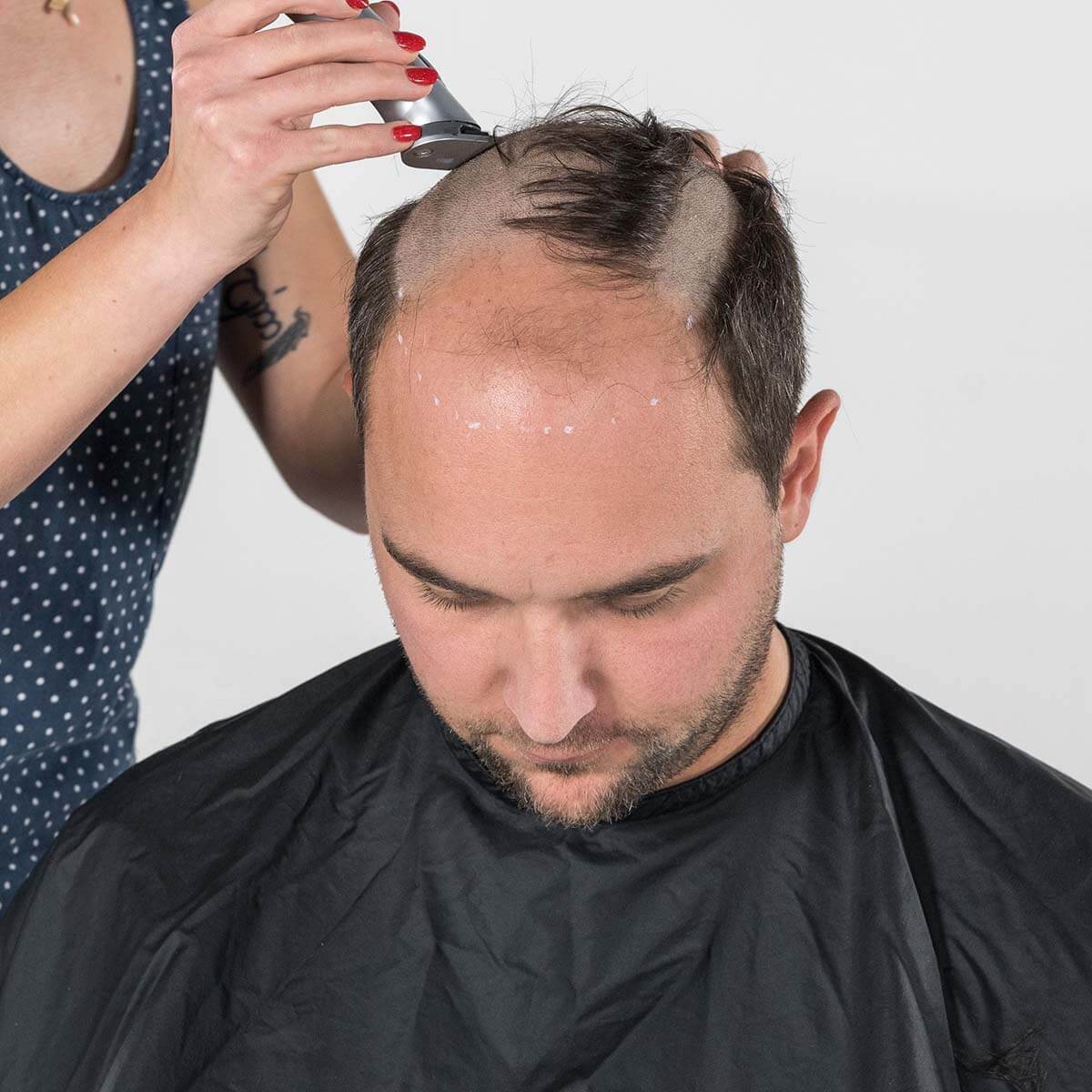 Abrasieren der Haare an den gekennzeichneten Stellen